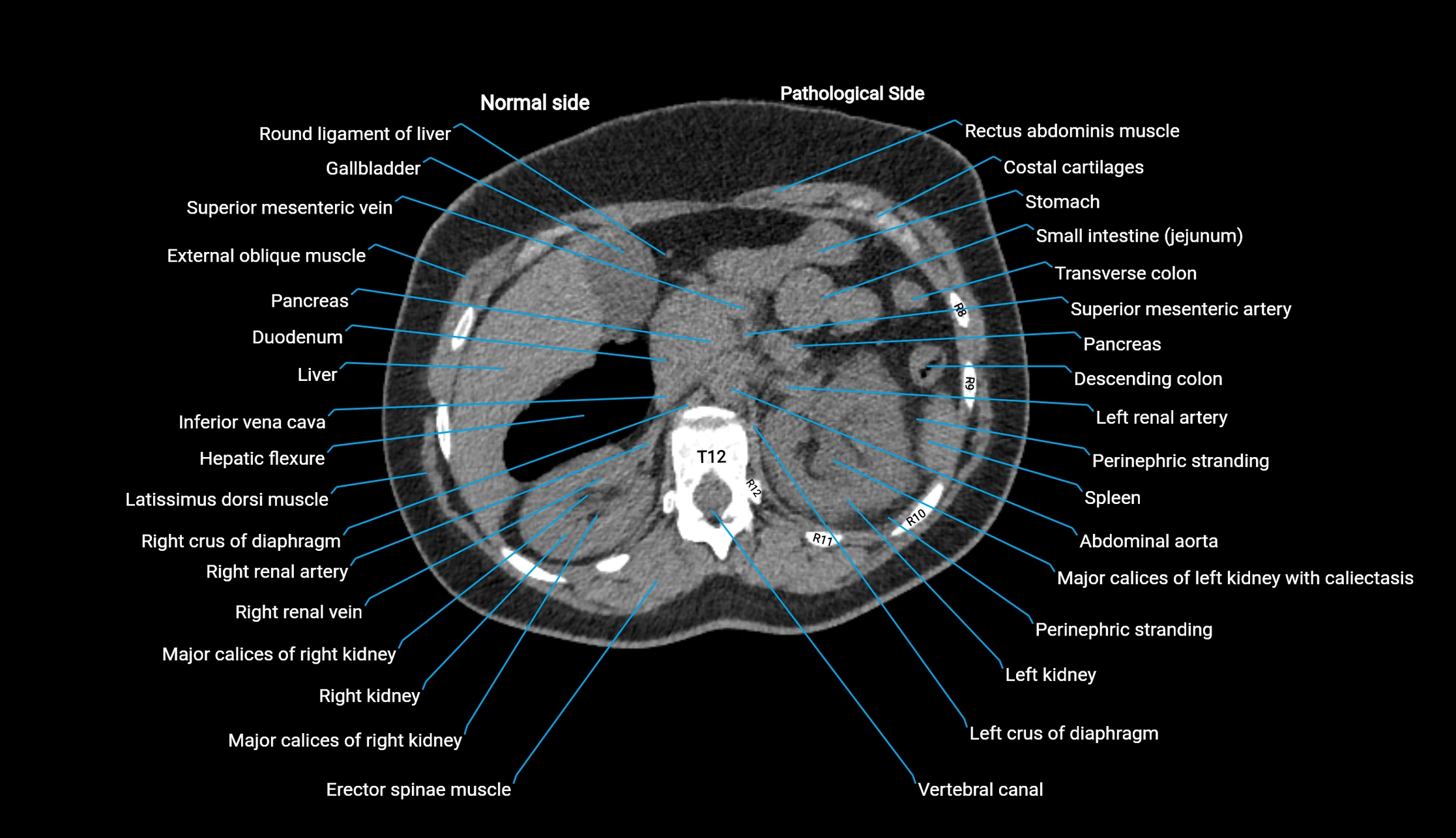 CT KUB axial cross sectional anatomy  radiology image -img-00201-00032.webp